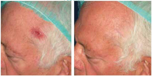 Basaliomas treatment results — before and after 4 sessions with Quaderma QQ-500 Pro