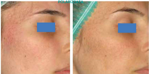Acne scars treatment results — before and after 4 sessions with Quaderma QQ-500 Pro