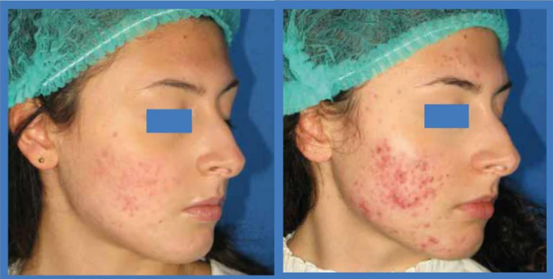 Acne vulgaris treatment results — before and after 6–8 sessions with Quaderma QQ-500 Flex