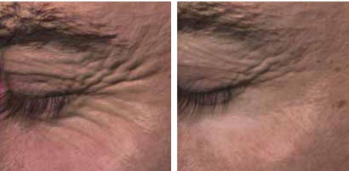 Photorejuvenation treatment results — before and after 4–6 sessions with Quaderma QQ-500 Pro